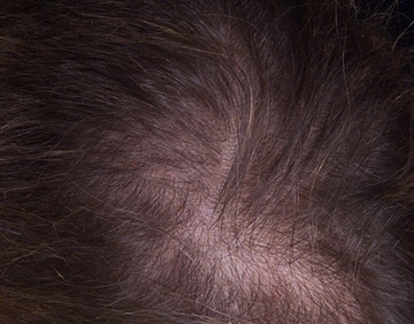 أعراض تساقط الشعر للرجال