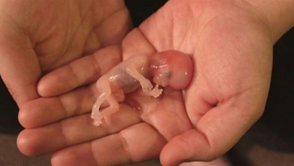 دعاء اجهاض الجنين - شكل إجهاض الجنين في الشهر الأول ٥