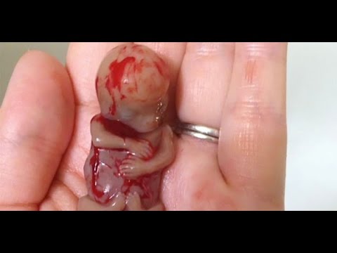 - دعاء اجهاض الجنين - شكل إجهاض الجنين في الشهر الأول ٢