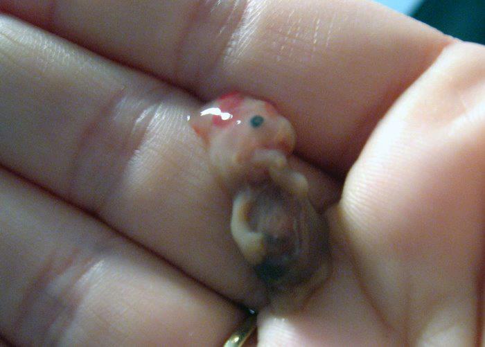 شكل إجهاض الجنين في الشهر الأول ٣