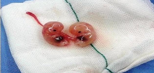 شكل إجهاض الجنين في الشهر الأول ١