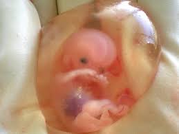 شكل كيس الحمل بعد الإجهاض بالصور 