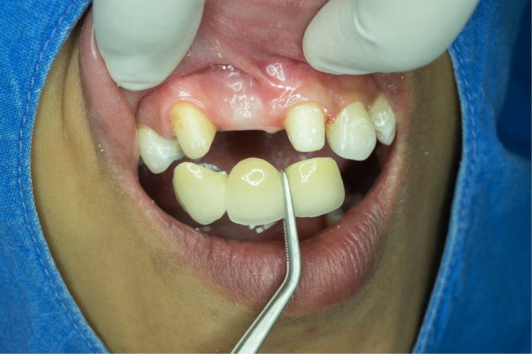  طريقة إزالة جسر الأسنان