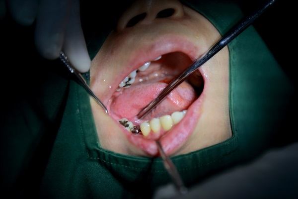  تجارب الناس مع زراعة الاسنان 
