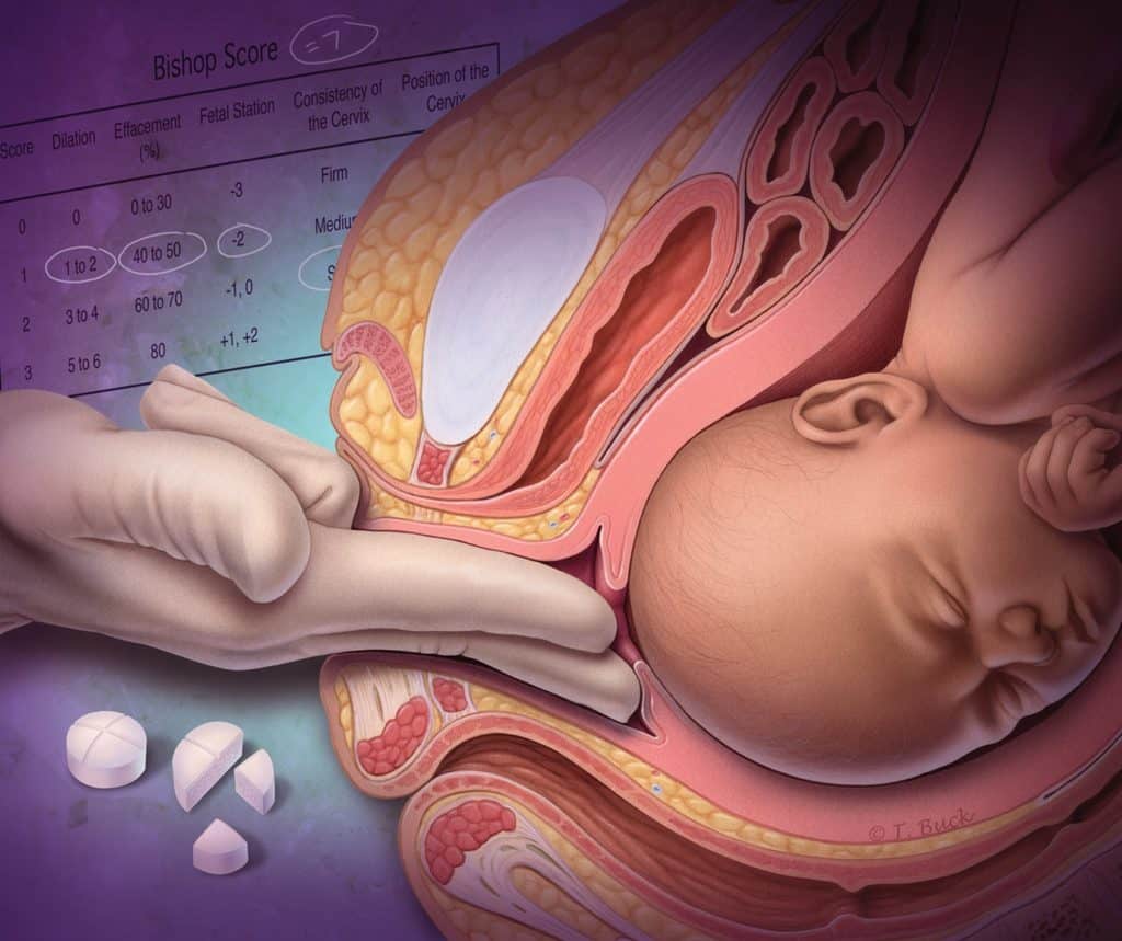  توسيع الرحم باليد للولادة 