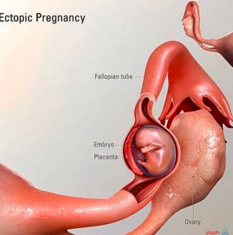 كيف اعرف أن الرحم رجع لوضعه الطبيعي بعد الولادة