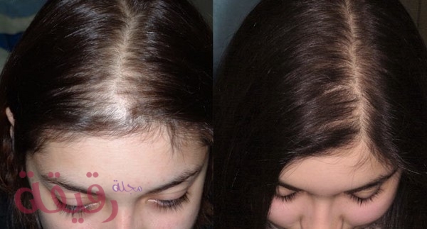  زراعة الشعر للنساء قبل وبعد 