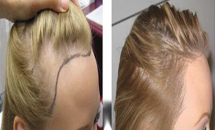 زراعة الشعر للنساء قبل وبعد 