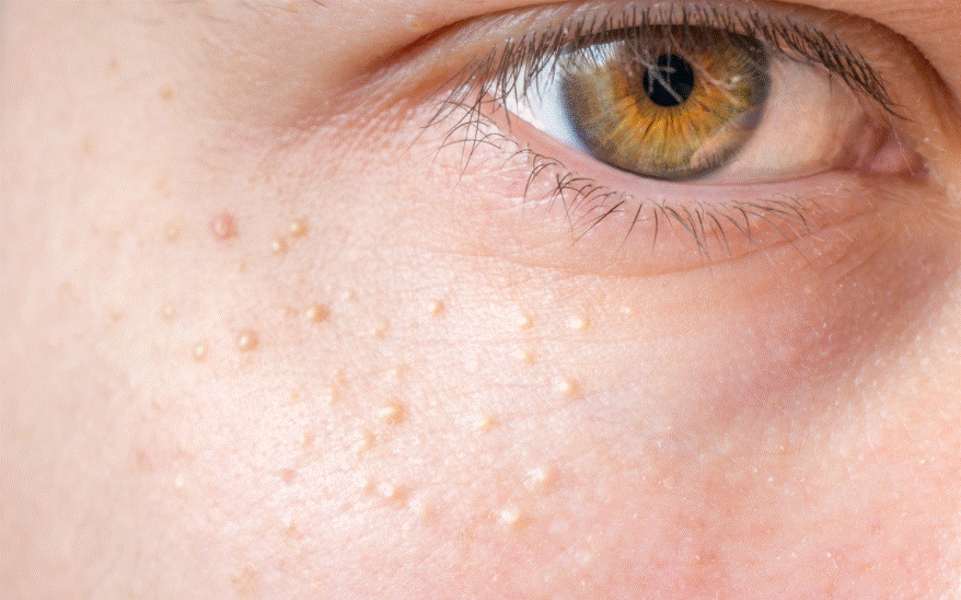 علاج الحبوب البيضاء تحت الجلد في الوجه