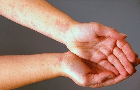 آيات علاج حساسية الجلد