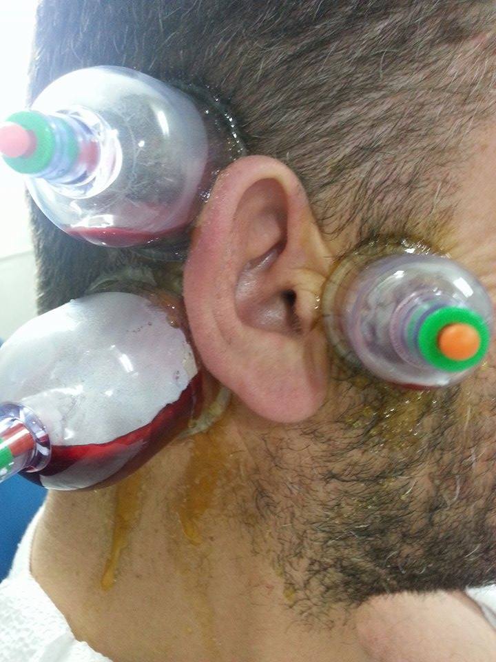 علاج ضعف السمع بالحجامة