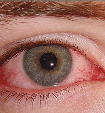 علاج أمراض العين بالقران