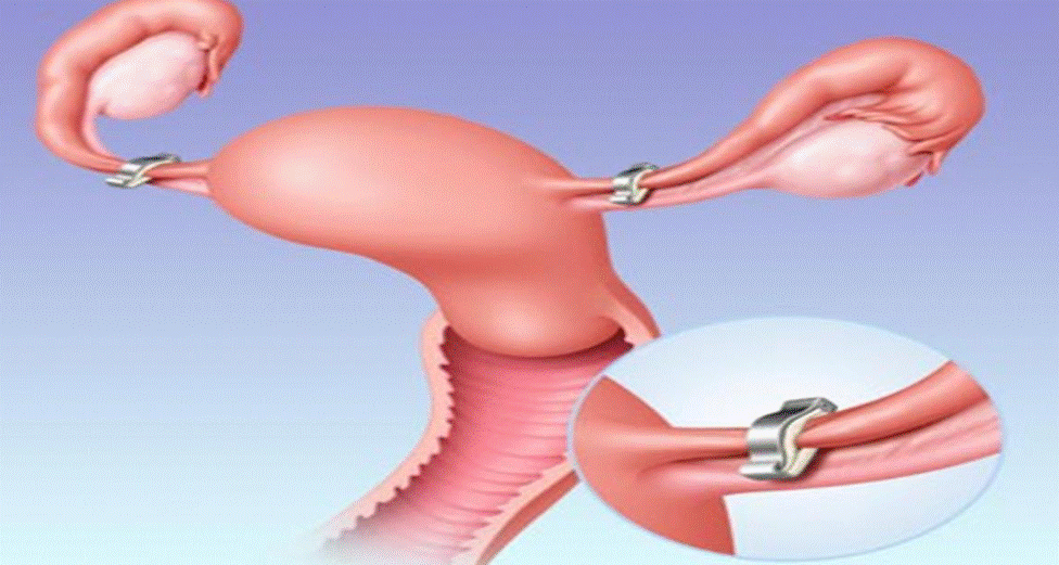 تجربتي مع عملية ربط عنق الرحم إقرأ تجربتي مع عملية ربط عنق الرحم