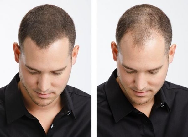 استخدام توبيك بعد زراعة الشعر