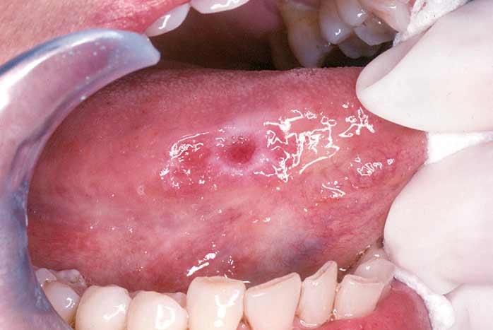 شكل سرطان الفم ٤