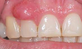 افضل مضاد حيوي لعلاج الخراج الاسنان