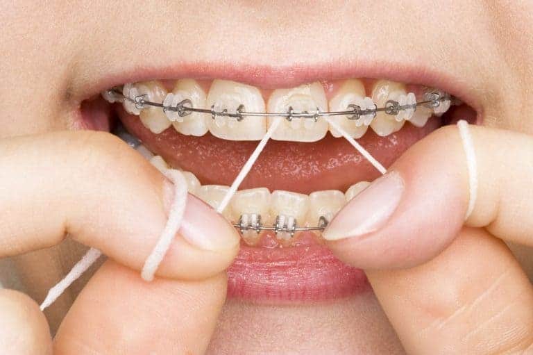 مكونات تقويم الأسنان
