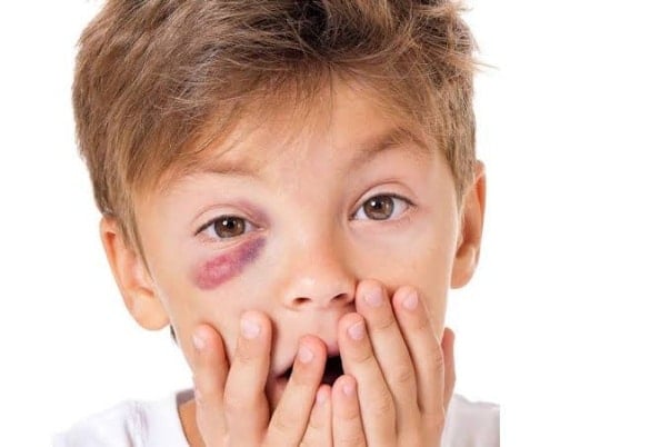 علاج كدمات العين للاطفال
