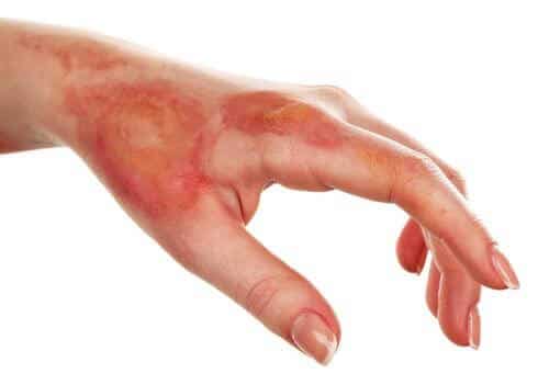 علاج كدمات اليد - ازالة زراق الكدمات 