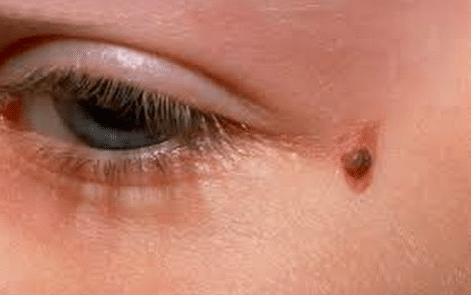 الزوائد الجلدية حول العين عند الأطفال 