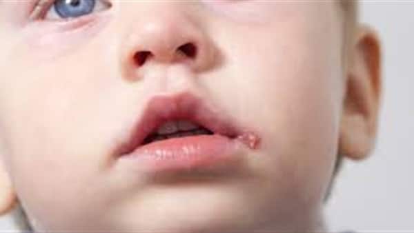 علاج الثآليل في الوجه للاطفال