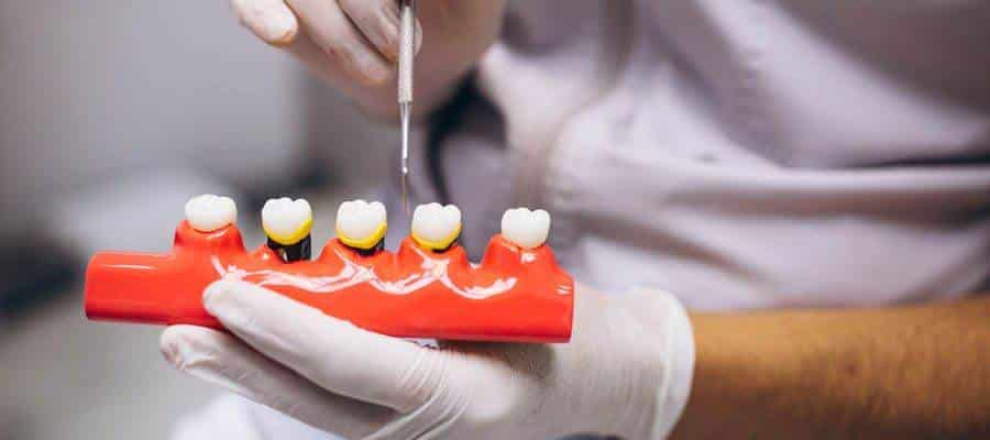 زراعة الأسنان الفورية في الرياض