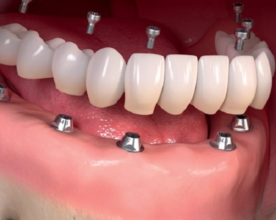 زراعة الاسنان الفورية في الاردن