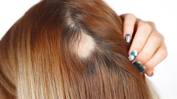 علاج الثعلبة في الشعر عند النساء