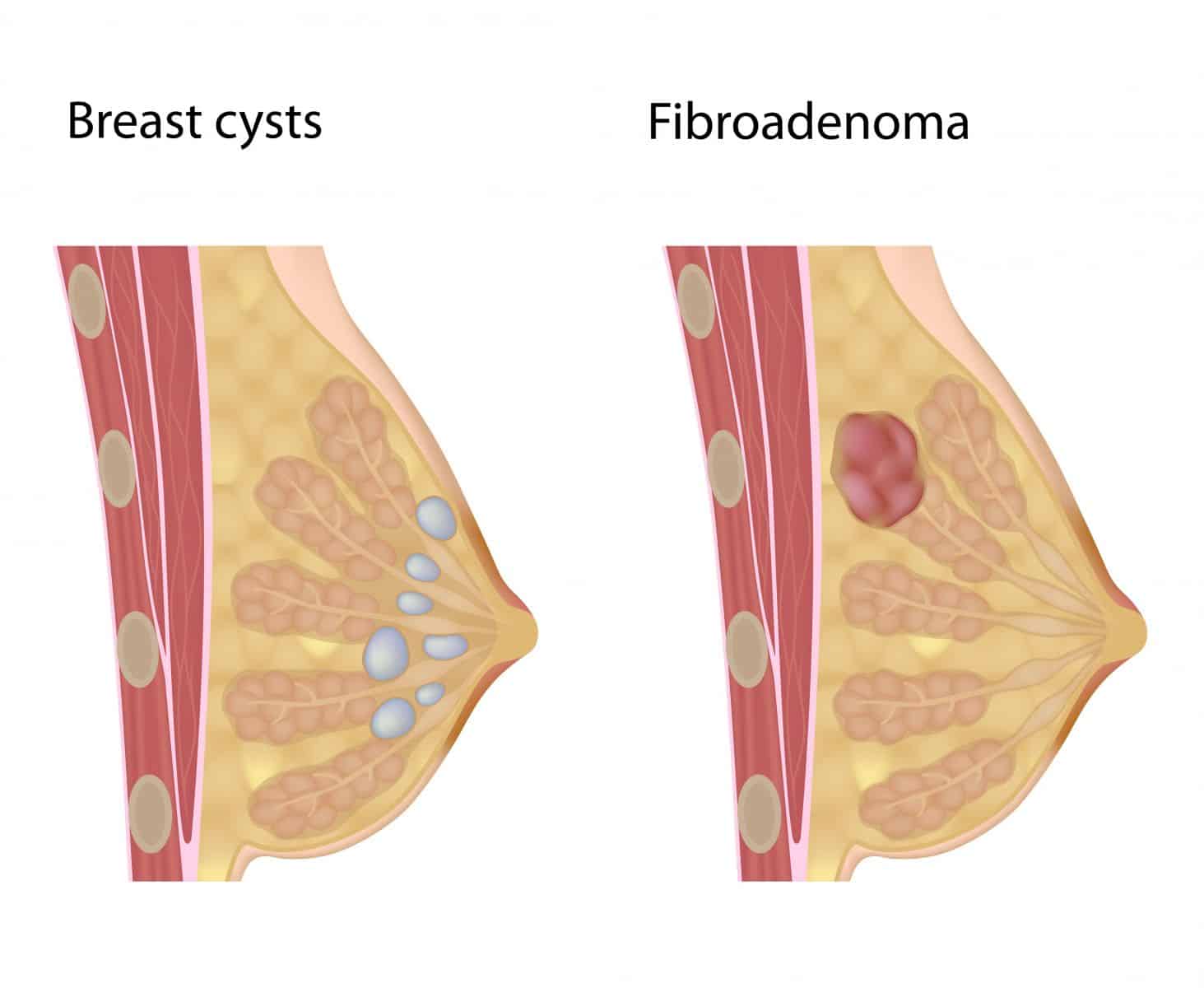 الفرق بين الكيس و الفيبروم في الثدي