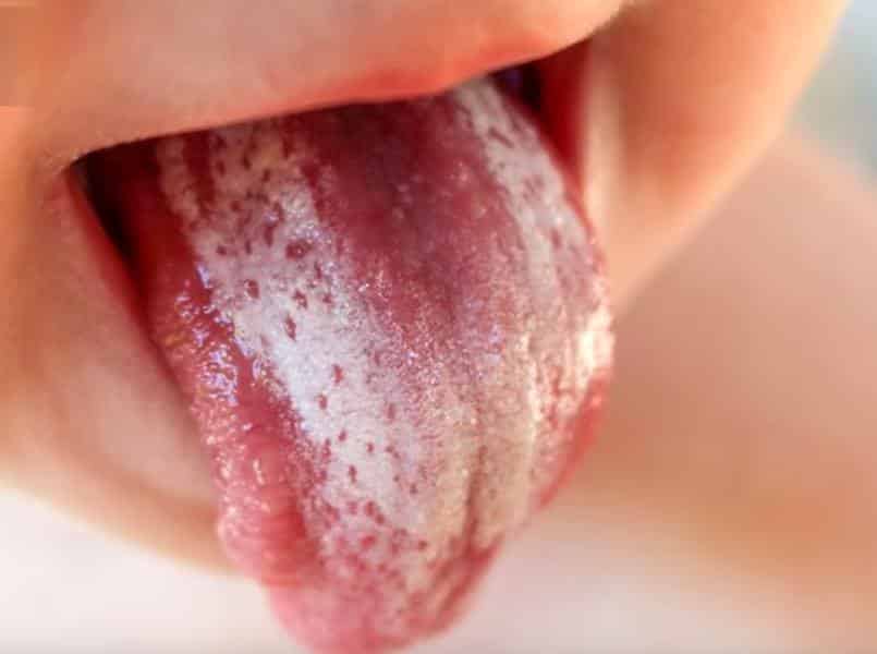 تجاربكم مع فطريات الفم للاطفال