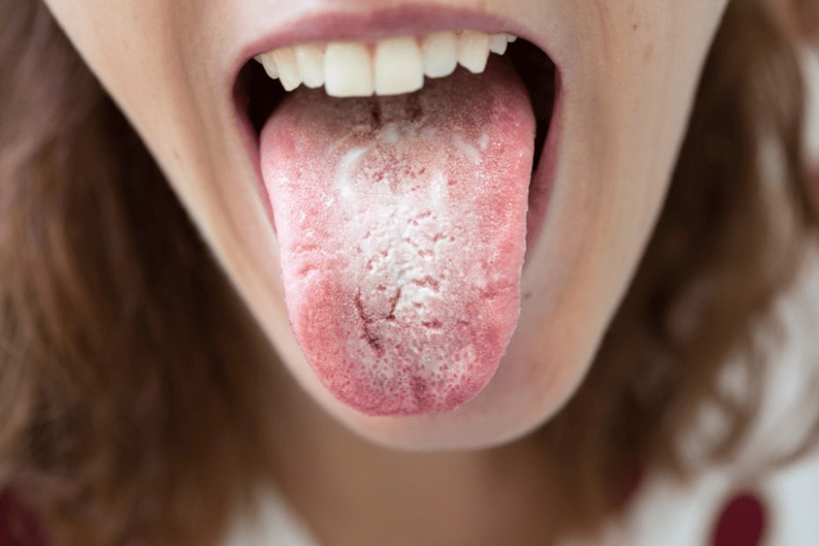 علاج فطريات الفم طبيعيا 