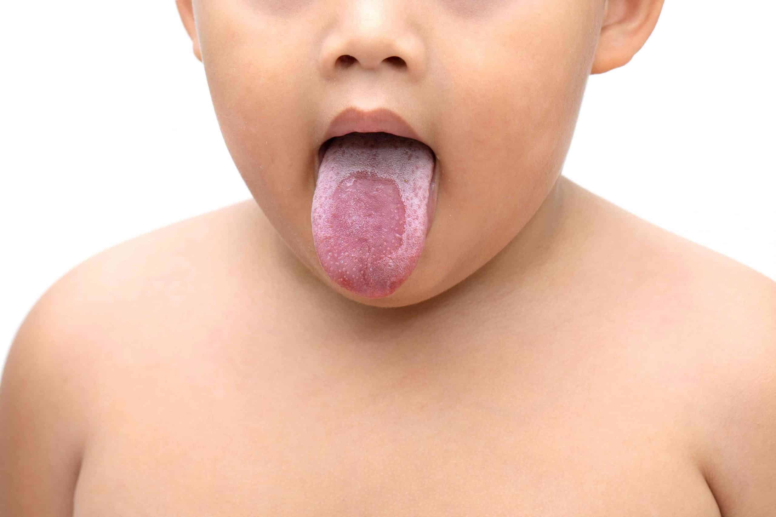 تجاربكم مع فطريات الفم للاطفال
