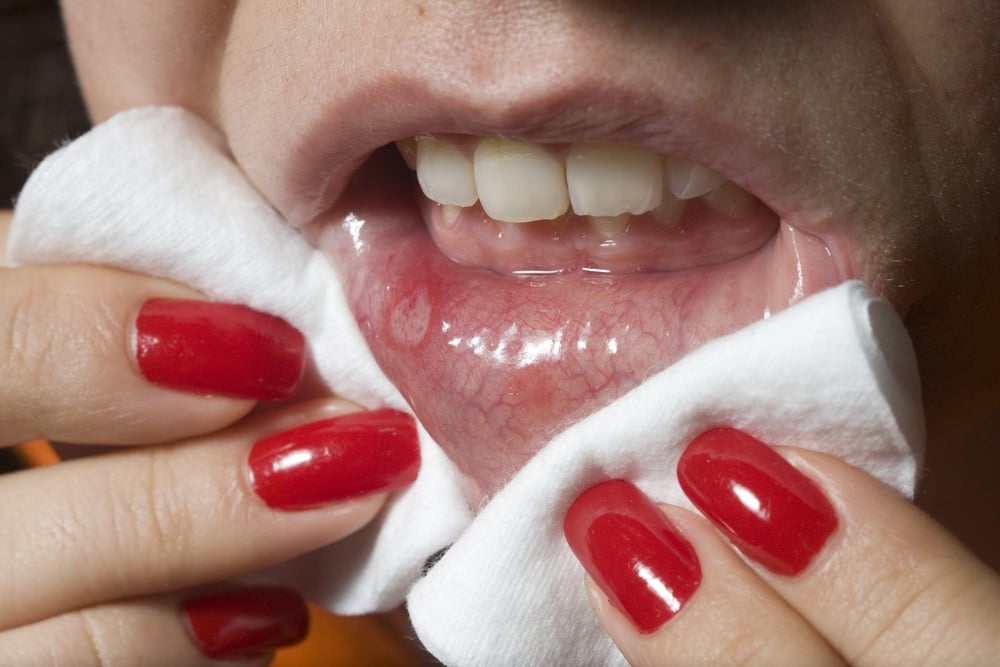 علاج كانديدا الفم 