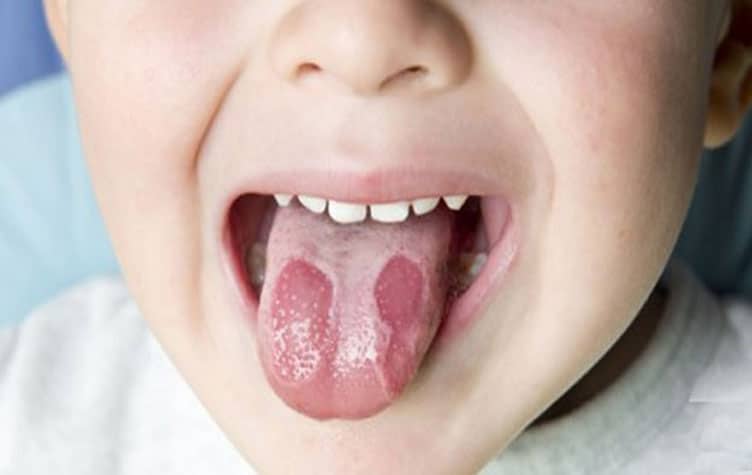 علاج فطريات الفم بالأدوية 