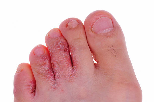 علاج فطريات القدم بين الأصابع