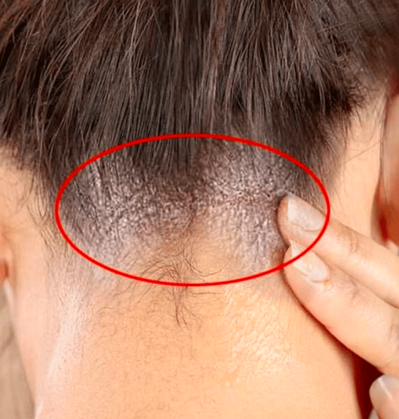 أعراض فطريات الشعر