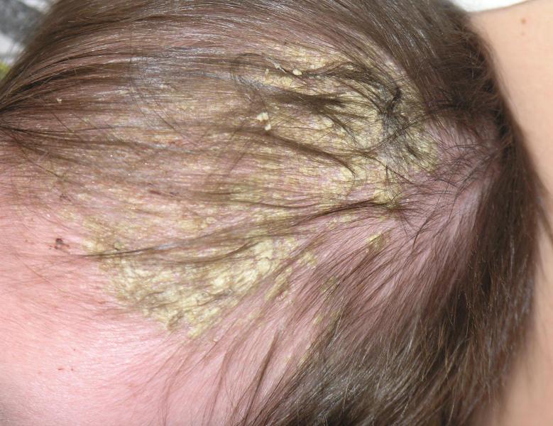 علاج الحزاز في الشعر