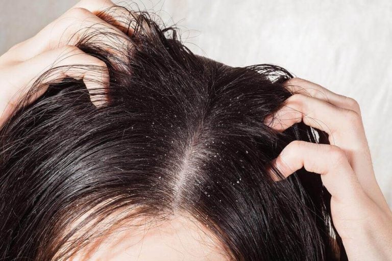 نصائح علاج فطريات الشعر