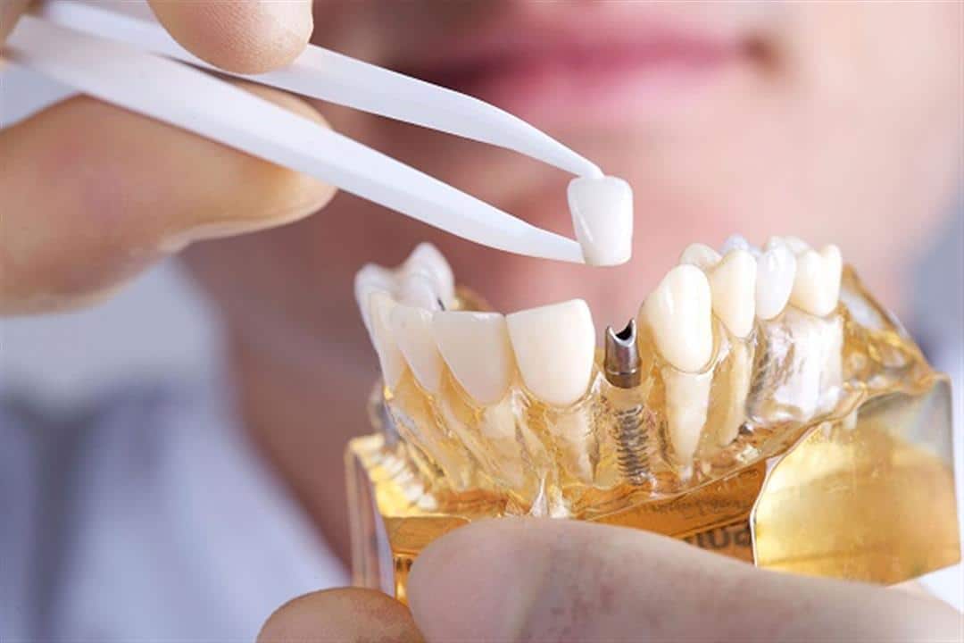 مميزات وعيوب زرع الاسنان