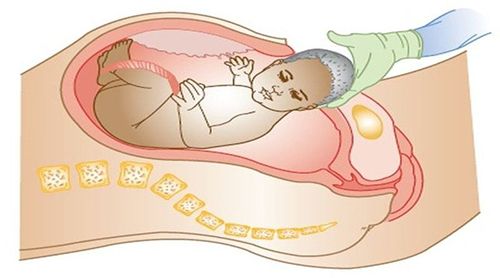 نصائح لجرح الولادة القيصرية